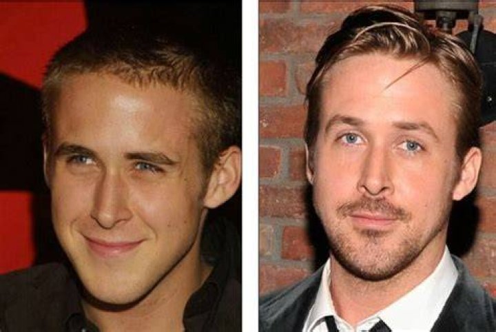 Has Ryan Gosling Received A Nose Job?